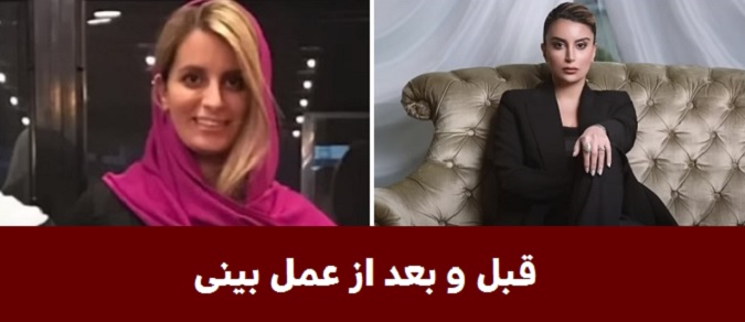 نگار فرهمند قبل عمل