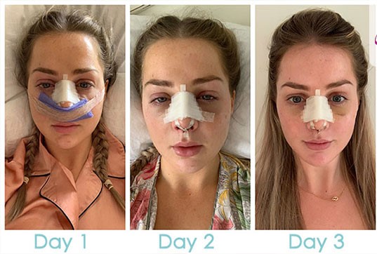 عکس بینی عمل شده بعد از یک هفته