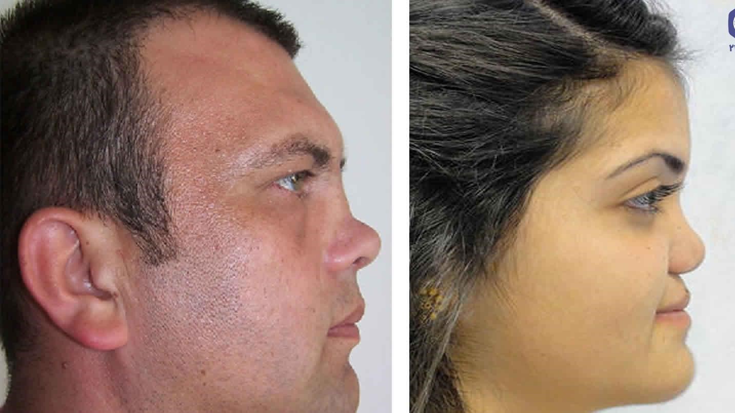 عکس عمل بینی زشت