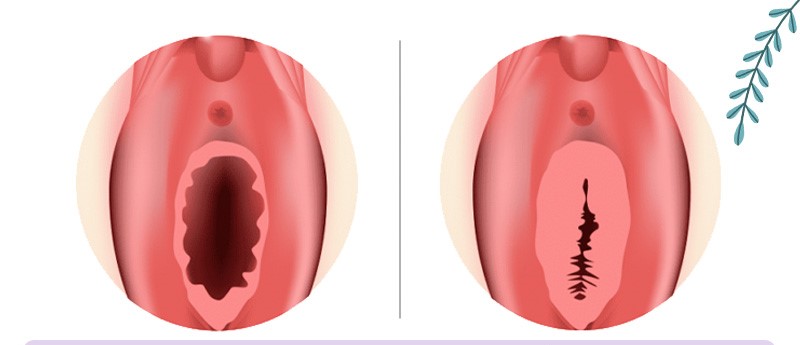 عکس لابیا پلاستی