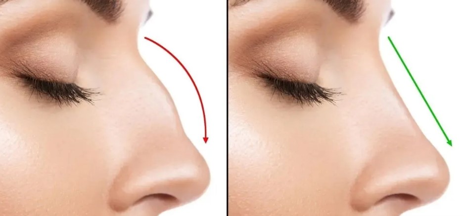 قوز بینی ترند